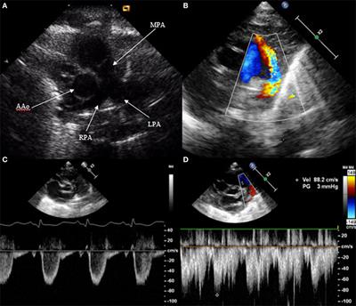 Echocardiographic Evaluation of Patent Ductus Arteriosus in Preterm Infants